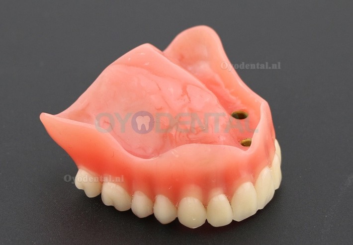 Tandheelkundige studie Tanden Model Overdenture met 4 implantaten Demo Model 6001